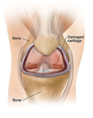 Front view of knee joint showing inflammation and arthritis.