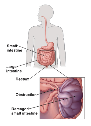 Outline of person showing digestive system, pointing out small intestine, large intestine, and rectum. Detail of obstruction and damaged small intestine.