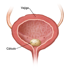 Corte transversal de la vejiga donde puede verse el cálculo vesical.