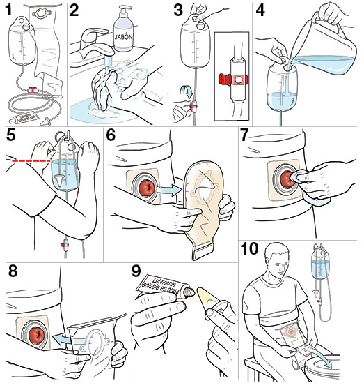 10 pasos para prepararse para irrigar un estoma.