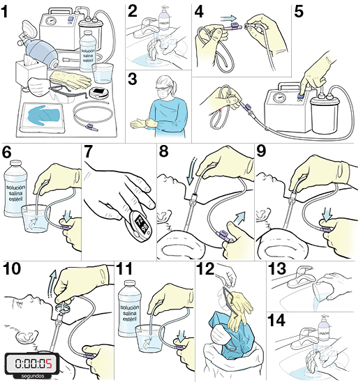 Instrucciones paso a paso para el cambio de una sonda de traqueostomía en niños.