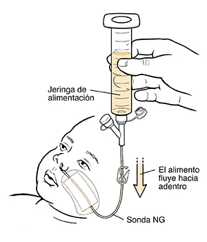 Mano sosteniendo una jeringa llena de alimento líquido conectada a una sonda nasogástrica de un niño pequeño. El alimento fluye desde la jeringa hasta la sonda.