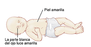 Bebé con la piel y la parte blanca de los ojos amarillentas debido a ictericia.