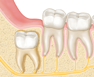 Dientes vistos en corte transversal de una mandíbula. La muela de juicio se encuentra en el hueso debajo de la encía, apuntando recta hacia arriba.