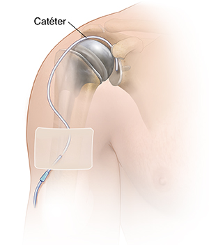 Vista frontal de la parte superior del brazo que muestra el catéter insertado en la articulación del hombro.