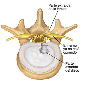 Vista superior de vértebra y disco. Se quitó parte del disco desde el lado posterior, y se quitó parte de la lámina. El nervio ya no está pinzado.