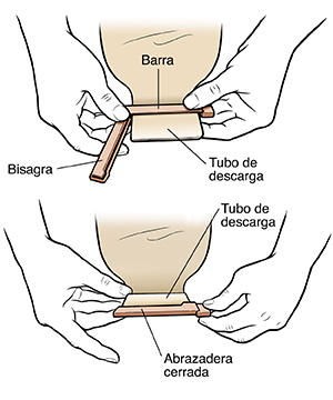 Manos que colocan un clip sobre el extremo de la bolsa de ostomía.