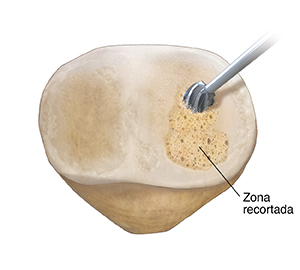 Vista posterior de la rótula donde puede verse un instrumento que corta el cartílago dañado.