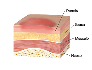 Corte transversal de la piel, el músculo y el hueso donde se observa la primera etapa de la lesión por presión. Las capas superiores de la piel se hinchan.