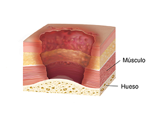 Corte transversal de la piel, el músculo y el hueso donde se observa una lesión por presión en la cuarta etapa, con pérdida de espesor de la piel y exposición del músculo y del hueso.