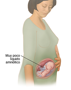 Vista de tres cuartos de una mujer embarazada en la que se muestra el feto en el útero con muy poco líquido amniótico.