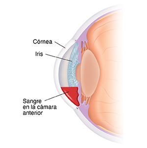 Vista de una sección cruzada del ojo mostrando sangre en la cámara anterior.