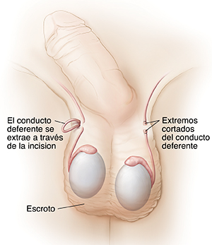 Vista frontal de un pene y un escroto donde pueden verse los conductos deferentes durante una vasectomía y después.