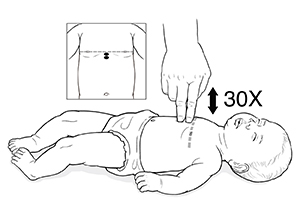 Bebé tumbado sobre la espalda. Mano adulta que realiza la RCP presionando el pecho con dos dedos. Recuadro del torso de un niño pequeño con una línea de puntos y dos puntos donde se observa la colocación de los dedos en el centro del pecho y justo debajo de la línea de las tetillas.